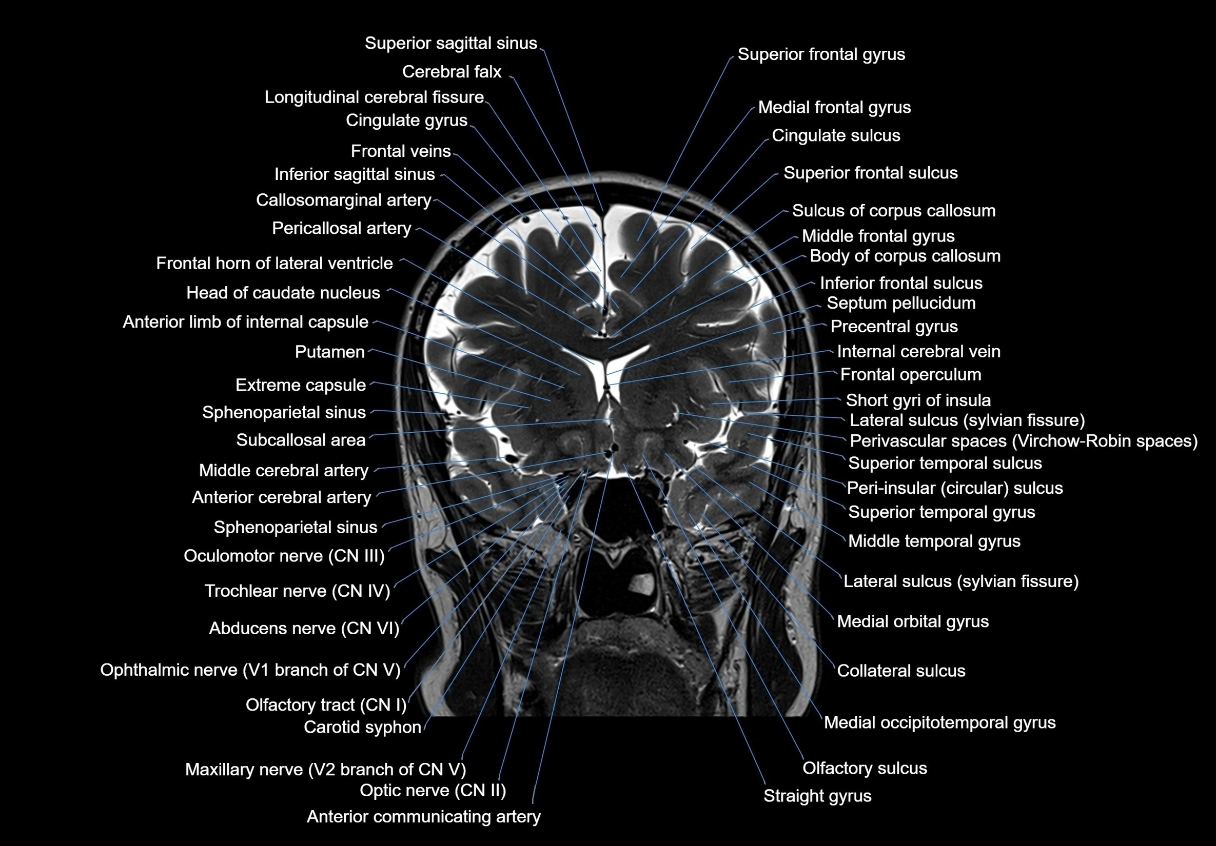 MRI Brain coronal cross sectional labelled anatomy 3T image  -img-00001-00028.webp